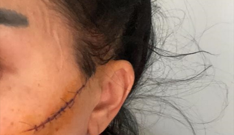 Adana’da eski erkek arkadaşının usturalı saldırısına uğradığı iddia edilen kadın yaralandı