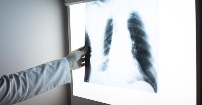 Tüberküloz her yıl 1,5 milyondan fazla kişinin canına mal oluyor