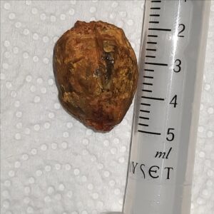 DENİZLİ (AA) – Denizli'de, 74 yaşındaki kadının safra kesesinde bulunan