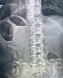 AĞRI (AA) – Ağrı'nın Doğubayazıt ilçesinde vücudunda 55 kapsül halinde