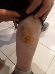 ​​​​​​​HATAY (AA) – Hatay'ın Samandağ ilçesinde sahipsiz köpeklerin saldırısına uğrayan