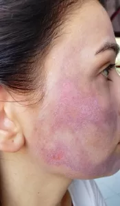 - Cilt yenileme işlemi yapılırken yüzünde iz kalan kadının şikayetiyle