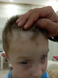 KARABÜK (AA) – Karabük'te sokak köpeklerinin saldırısına uğrayan 4 yaşındaki