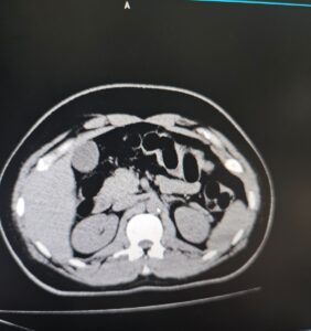 MUŞ (AA) – Muş'ta yolcu otobüsündeki bir şüphelinin midesinde, kapsüllere