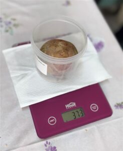 GİRESUN (AA) – Giresun'da bir hastanın mesanesinden ameliyatla 10 santimetre